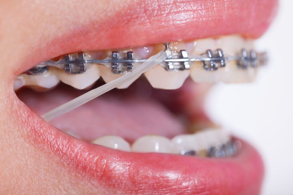 rubber bands